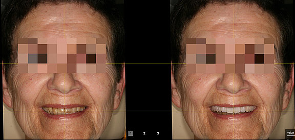 veneers_vorher_nachher.jpeg