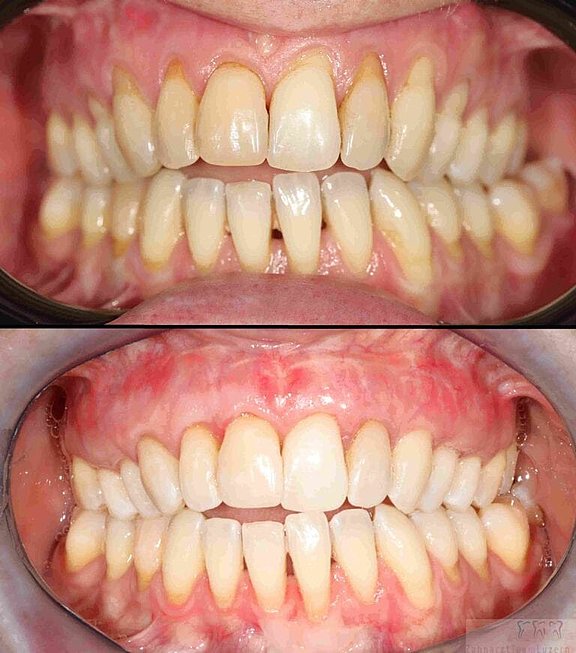 Zahnfleischaufbau-1-768x870__2_.jpg 