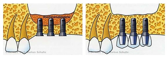 sinuslift-mit-gleichzeitiger-implantologie-zahnarzt-luzern__1_.jpg 