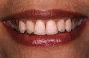 Gummy Smile after