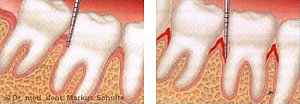 Picture: Measuring of the pockets - left healthy, right pocketing