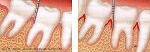 Messung der Zahnfleischtaschen - links gesundes Zahnfleisch, rechts Taschenbildung