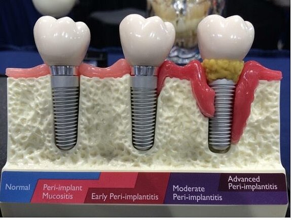 Periimplantitis-Parodontitis-am-Implantat-580x438.jpg 