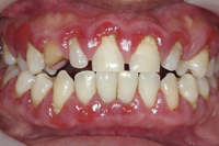 starke-gingivitis.jpg 