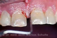 Gingivitis mit Taschenbildung und ausgeprägter Blutungsneigung