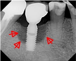 Das-Roentgenbild-Knochenkrater-Implantat.jpg 