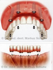 Implantatbruecken-zahnarzt.jpg 