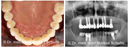 Implantate-im-Oberkiefer-Implantologie-1.jpg 