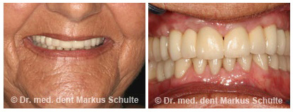 Implantate-im-Oberkiefer-Implantologie-2.jpg
