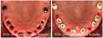 Implantate-im-Oberkiefer-Implantologie-3.jpg 