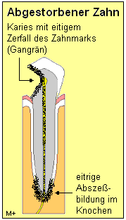 abgestorbener_zahn.gif 