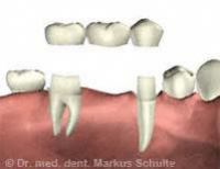 alternative-zum-einzelzahnimplantat.jpg 