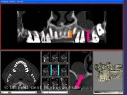 ct-bilder-implantatplanung.jpg