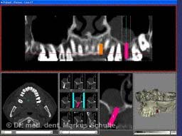 ct-bilder-implantatplanung.jpg 