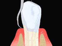 Deep Scaling - Ausschaben der Zahnfleischtaschen 