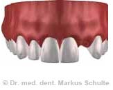 einzelzahn-implantat-3fr.jpg