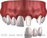 einzelzahn-implantat-4fr.jpg
