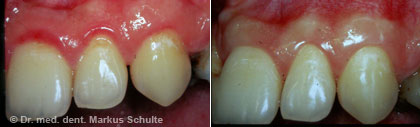 gingivitis-behandlung__2_.jpg
