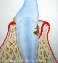 gingivitis-knochenschwund__2_.jpg