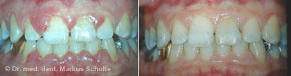 gingivitis-wucherung__2_.jpg