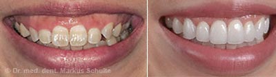 gummy-smile-1__3_.jpg