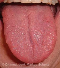 halitosis-zunge-gesund.jpg 