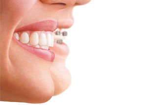 invisalign-ansicht.jpg 