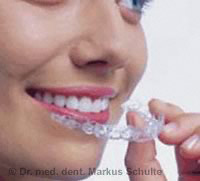 invisalign-schiene.jpg 