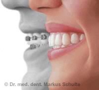 invisalign-schienen-vergleich.jpg 