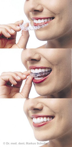 invisalign123.jpg 