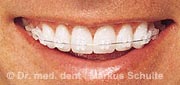 keramikbrackets.jpg