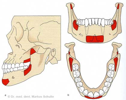 knochenaufbau-einleitung.jpg 