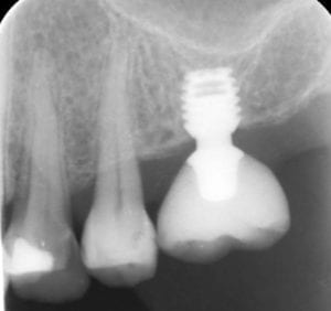 kurzes-implantat-300x282__1_.jpg
