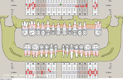 parodontitis-befund__1_.jpg 