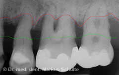 parodontitis-roentgenbild__1_.jpg 