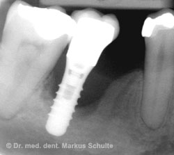 periimplantitis__2_.jpg