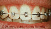 speed-brackets__1_.jpg