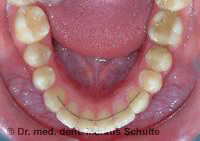 unterkiefer-drahtretainer.jpg