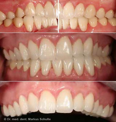 veneers-fall-1-nachher.jpg