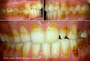 veneers-fall-1.jpg
