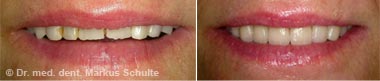 veneers-fall-2__1_.jpg