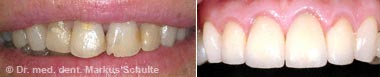 veneers-fall-3.jpg