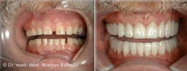 veneers-fall-4.jpg