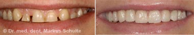 veneers-fall-5.jpg