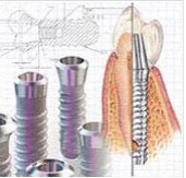 verschiedene-schraubimplantate-zahnarzt.jpg 