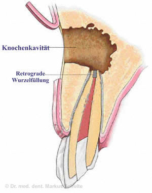 wurzelspitzenresektion-gross.jpg 