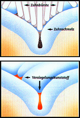 zahn-versiegeln.jpg 